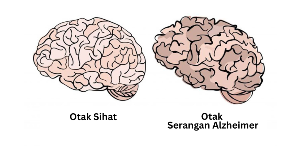 Kenali tanda-tanda alzheimer di usia muda untuk melindungi fungsi kognitif