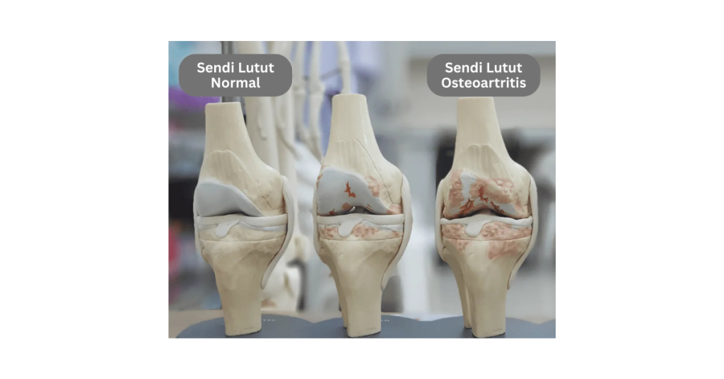 Perbandingan sendi lutut normal dan lutut di mana tulang rawan yang berfungsi sebagai pelapik pada hujung tulang bahagian menjadi sendi semakin haus akibat osteoartritis